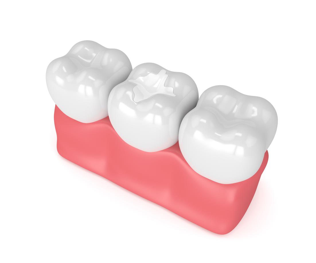5 Benefits of Tooth-Colored Fillings