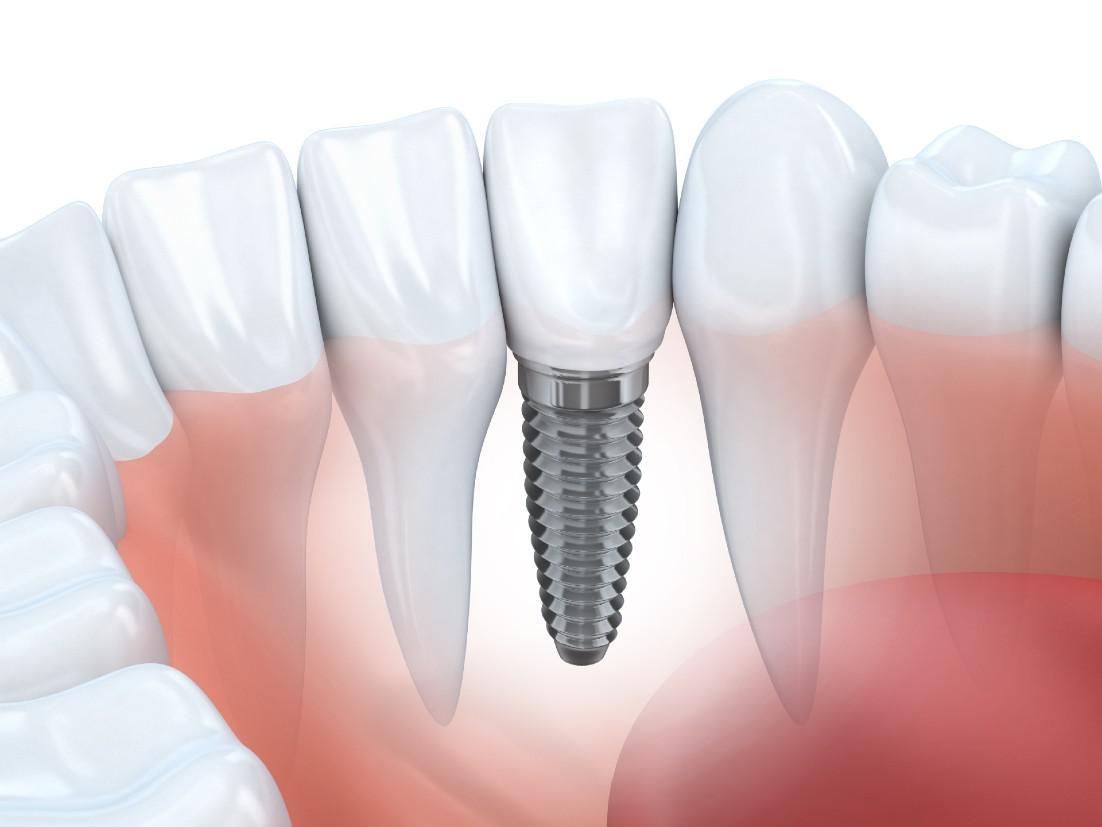 Dental Implants Manassas, VA